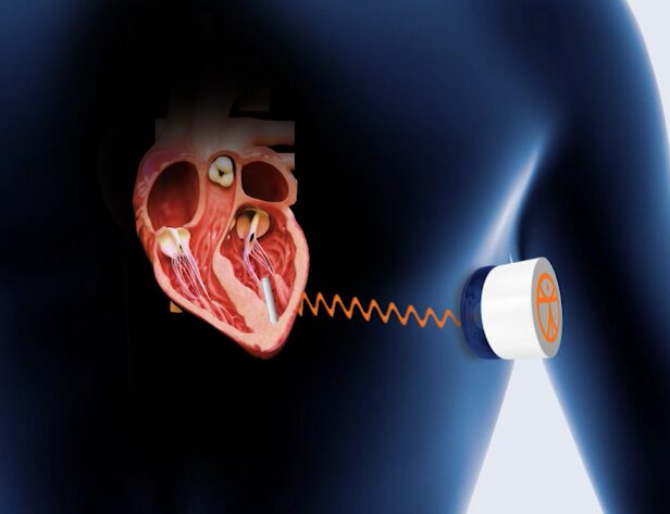 Transcutaneous Energy Transfer Vitruvens